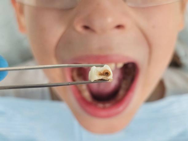 Best Emergency Root Canal Treatment in Alliae, NC